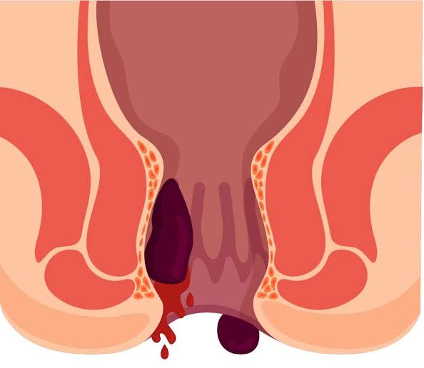 اعراض البواسير