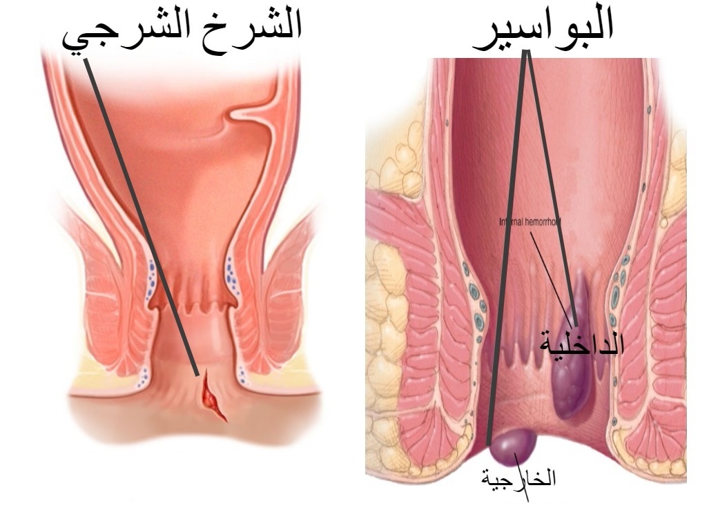 علاج البواسير