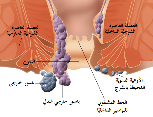 البواسير الخارجية