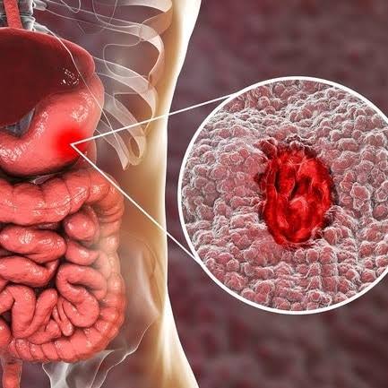 قرحة المعدة واسباب الاصابة بها