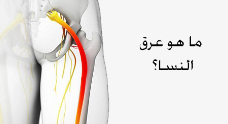 علاج عرق النسا