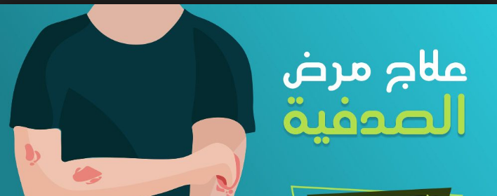 علاج الصدفية