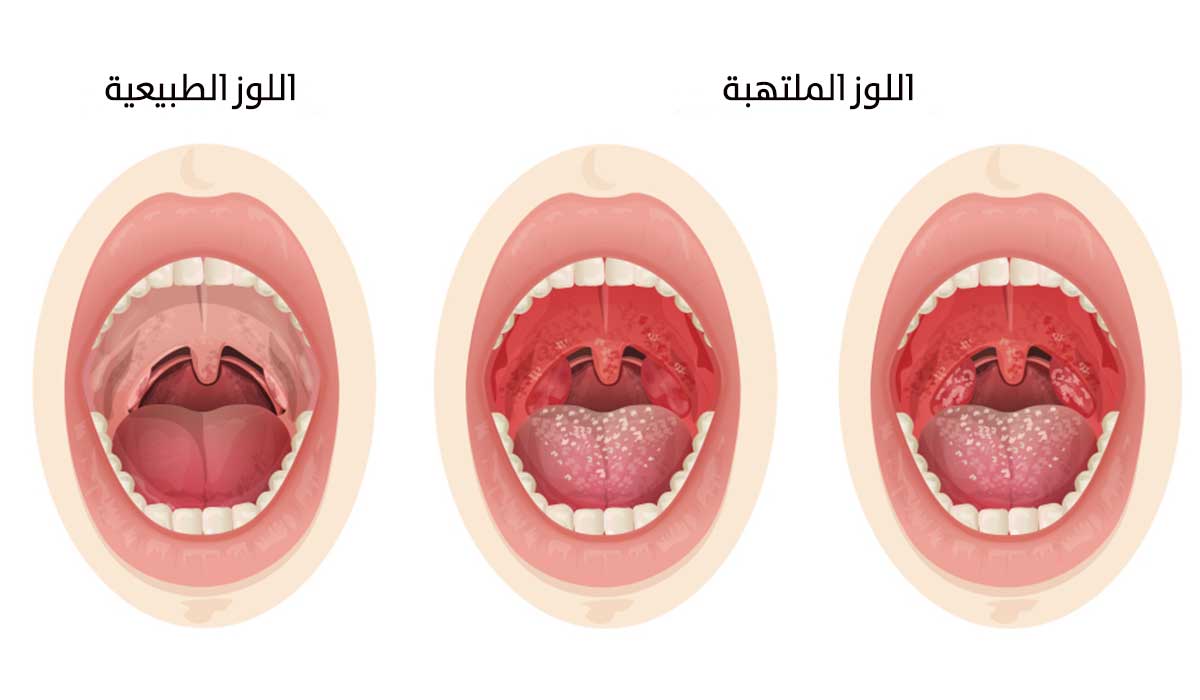 اللوز الملتهبة واللوز العادية