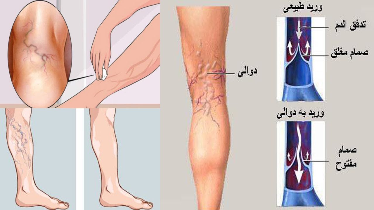 صورة توضح كيف تتم الاصابة بالدوالي