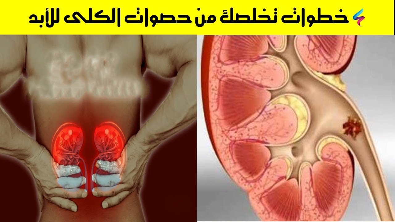 خطولت تخلصك من حصوات الكلى