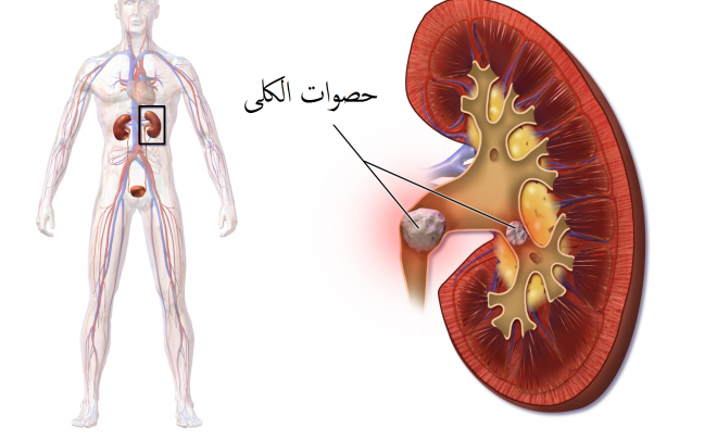 حصوات الكلى