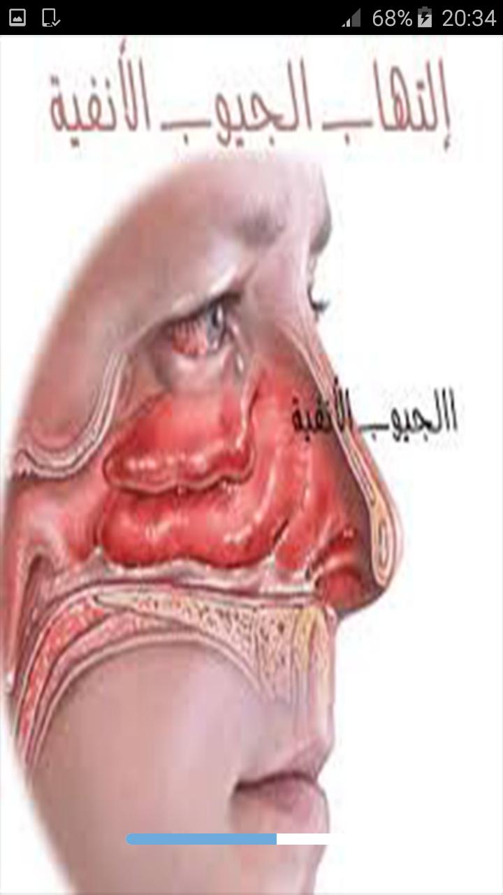 التهاب الجيوب الأنفية