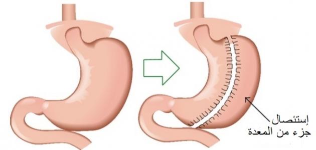 ماهو تكميم المعدة