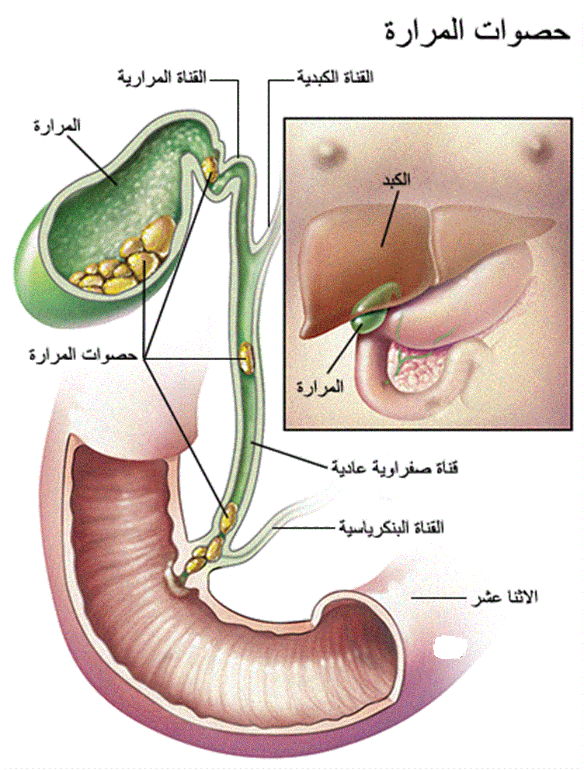 صورة توضيحية لمكان الحصوة.