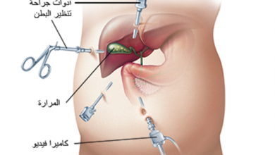 ما هو علاج حصوة المرارة بالجراحة؟