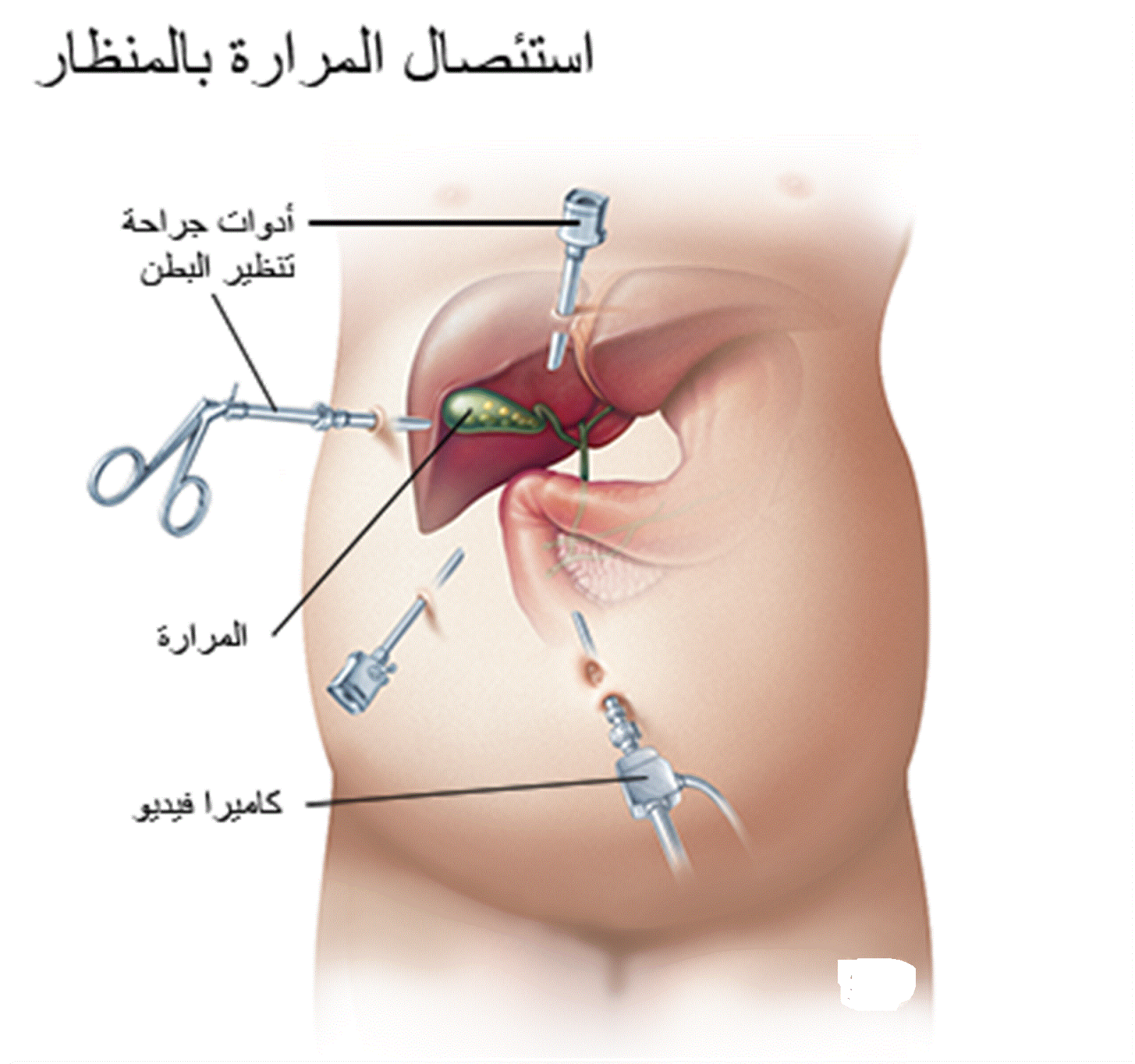 ما هو علاج حصوة المرارة بالجراحة؟