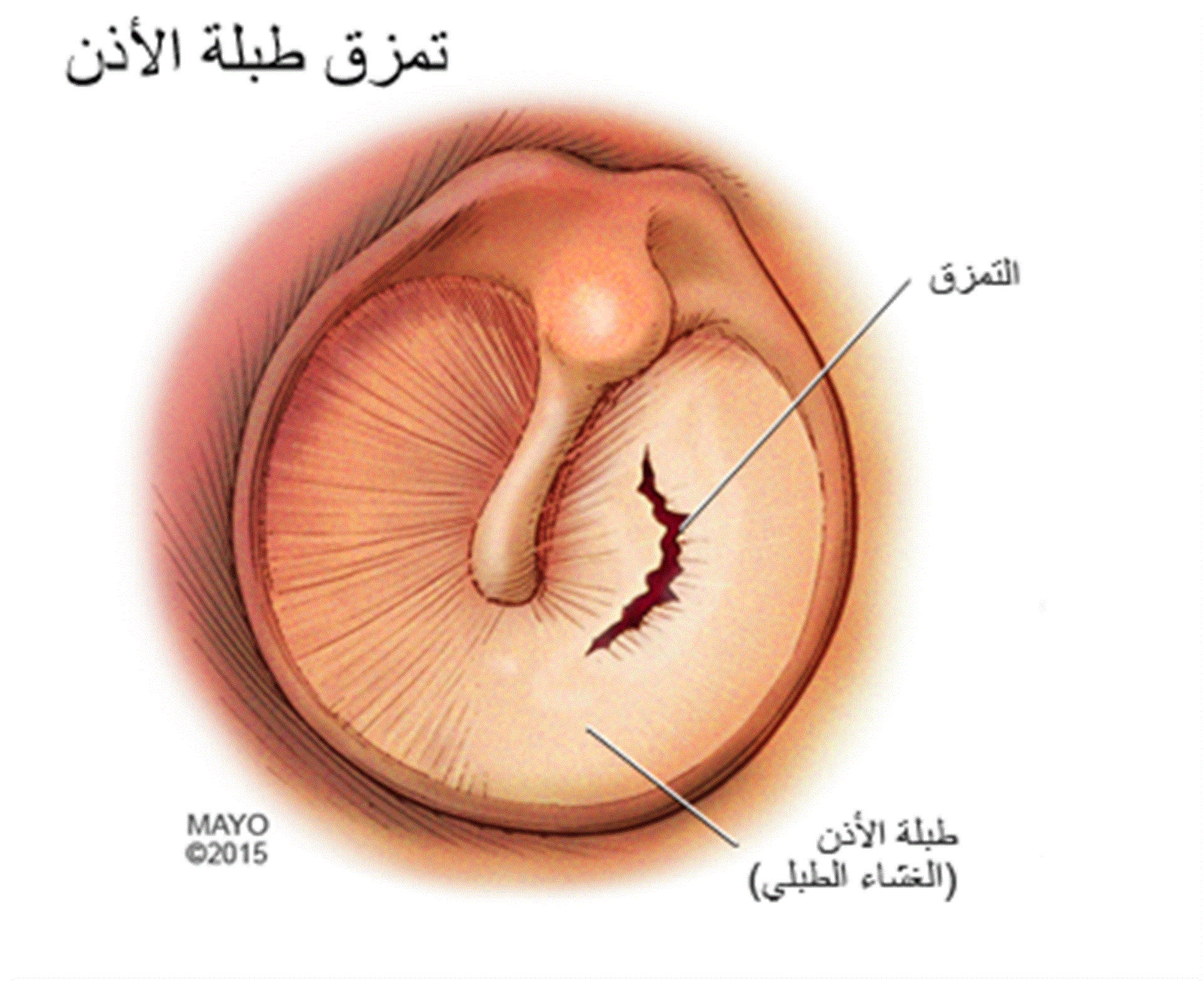 تمزق طبلة الأذن