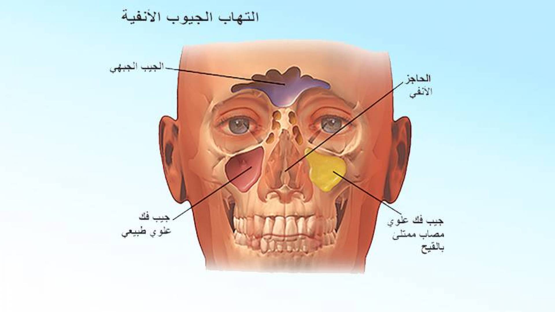 طريقة علاج الجيوب الانفية