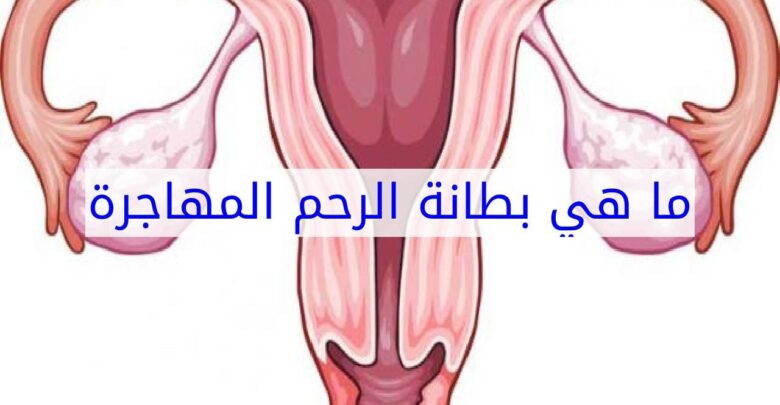 ما هي بطانة الرحم المهاجرة