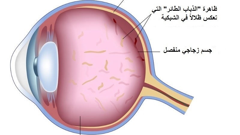 جلوكوما او ضغط العين 