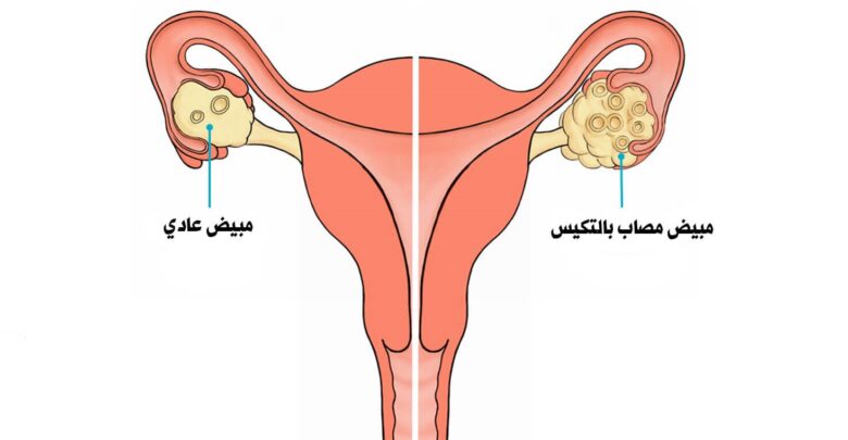 الرحم والمبياض