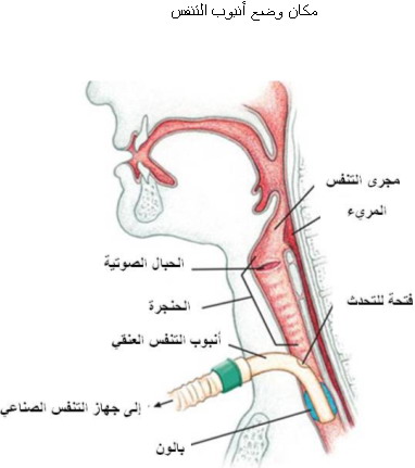 اين يوضع انبوب التنفس