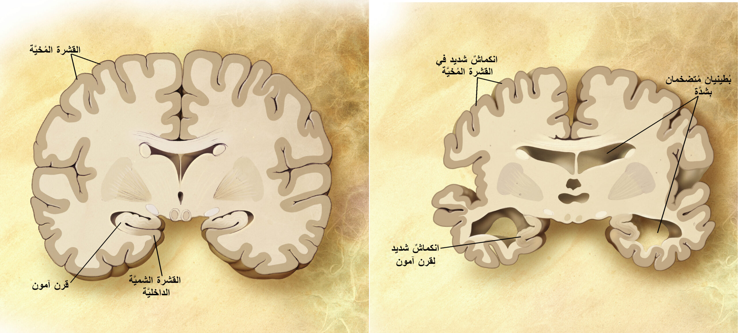 أضرار مرض الزهايمر