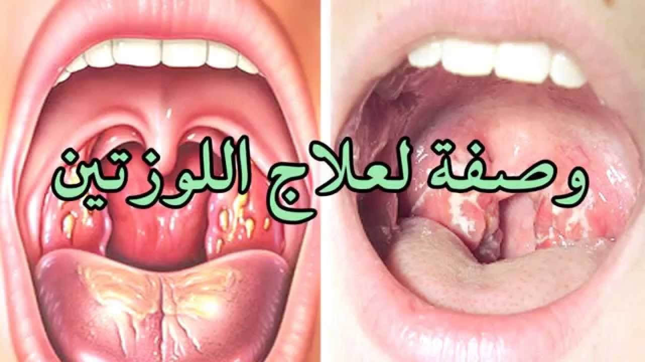 وصفة لعلاج اللوزتين