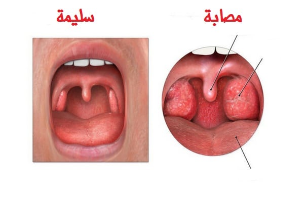 الحلق المصابة والسليمة