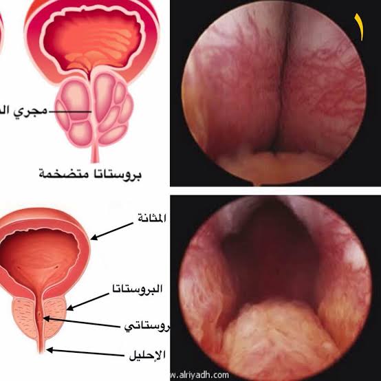 شكل البروستاتا