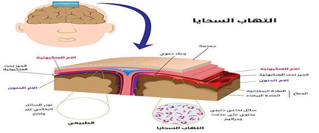 وصف التهاب السحايا