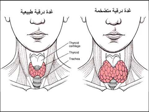 الفرق بين الغدة الدرقية السليمة و المتضررة