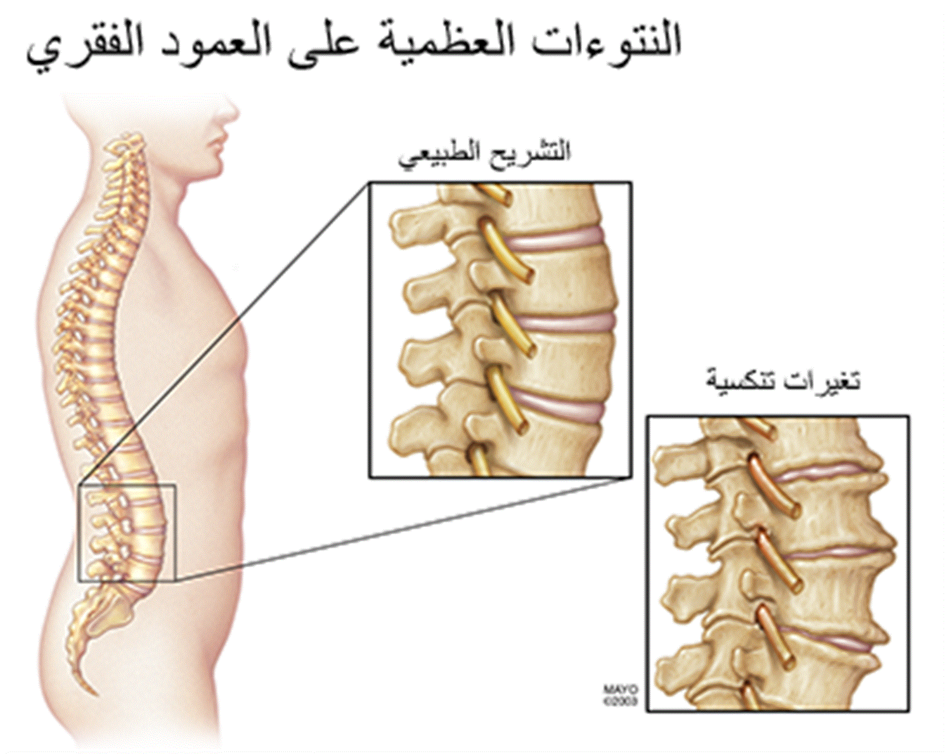 النتوءات العظمية