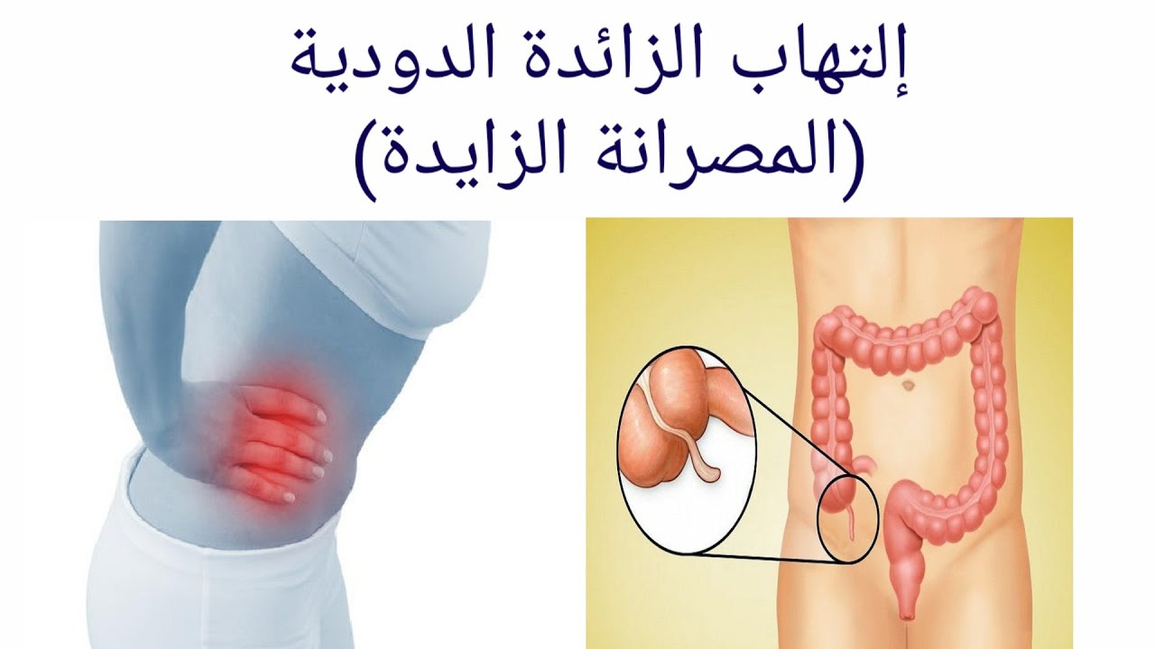 التهاب الزائدة الدودية