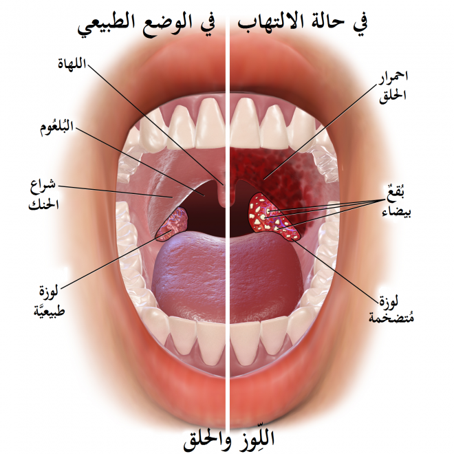 التهاب اللوزتين