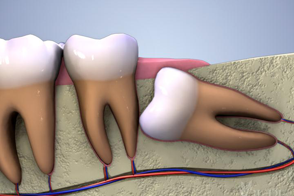 ضرس عقل غير ظاهر من اللثة