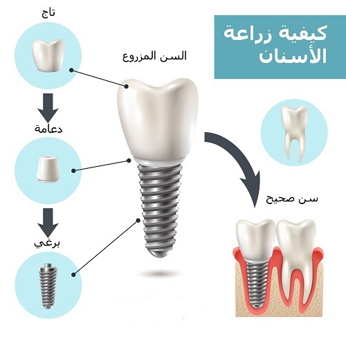 كيفية زراعة الاسنان