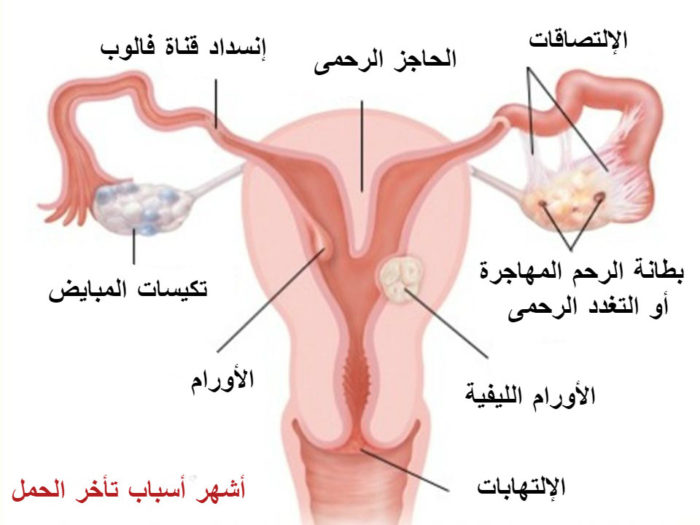 اسباب تأخر الانجاب 