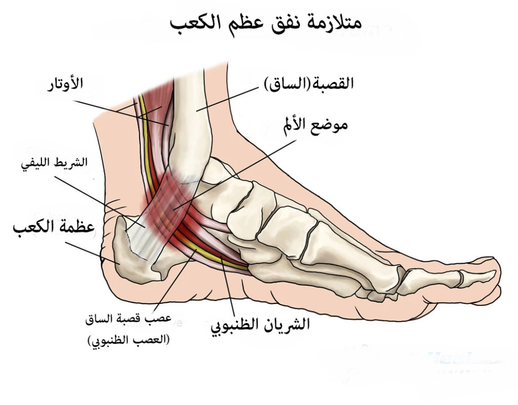 متلازمة القدم.