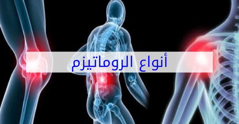 أنواع الروماتيزم