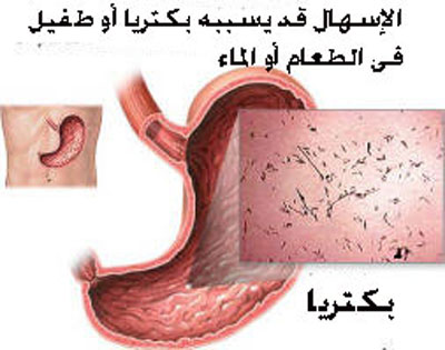 أسباب الإسهال المستمر