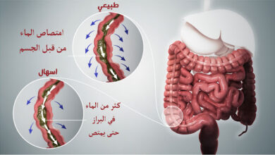 اعراض الإسهال المستمر