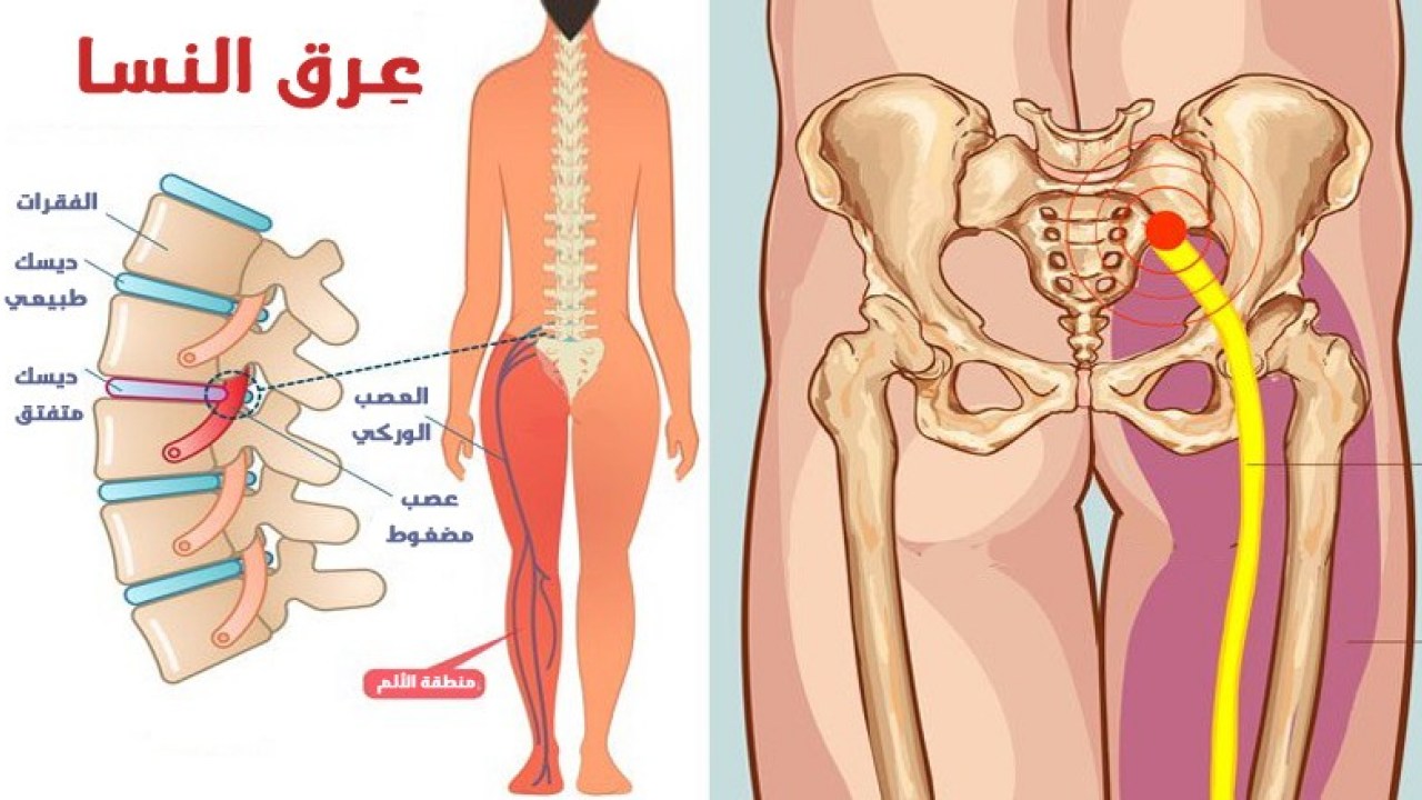 أسباب عرق النسا