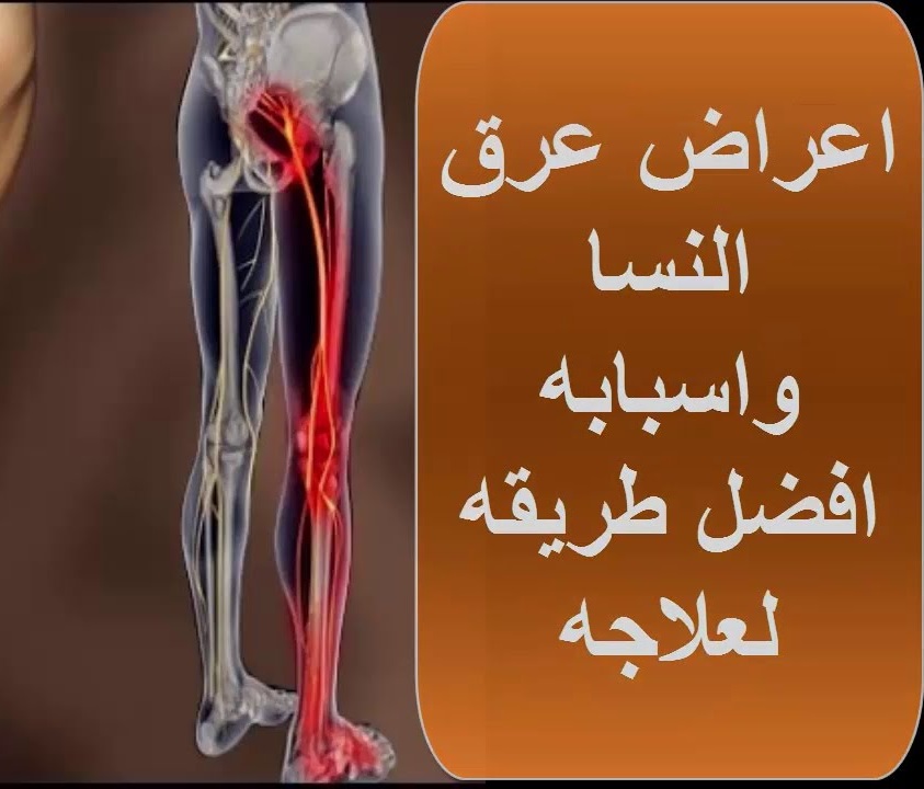 أعراض عرق النسا