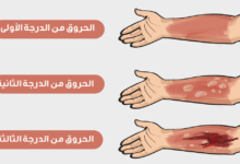 تتميز حروق الدرجة الأولى بـ ؟ ما هي مدة الشفاء من حروق الدرجة الأولى ؟