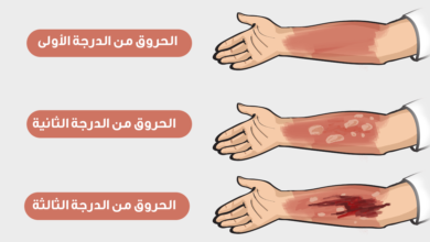 تتميز حروق الدرجة الأولى بـ ؟ ما هي مدة الشفاء من حروق الدرجة الأولى ؟