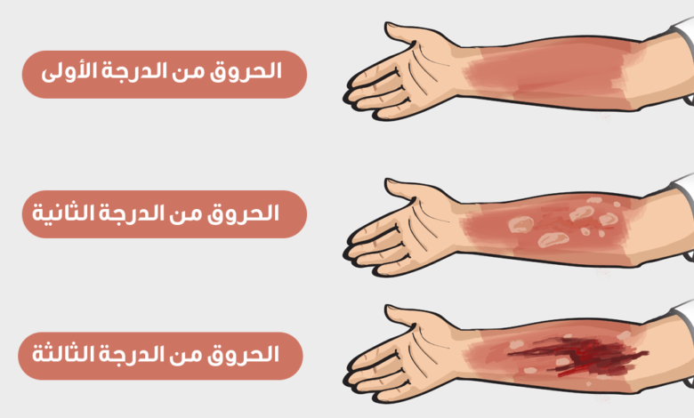 تتميز حروق الدرجة الأولى بـ ؟ ما هي مدة الشفاء من حروق الدرجة الأولى ؟