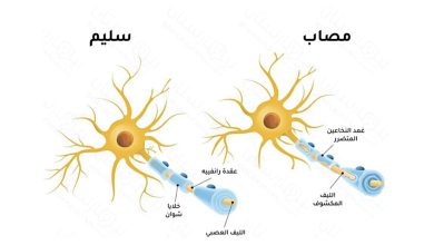 ما هو مرض التصلب اللويحي؟ هل هناك حالات شفيت من المرض؟